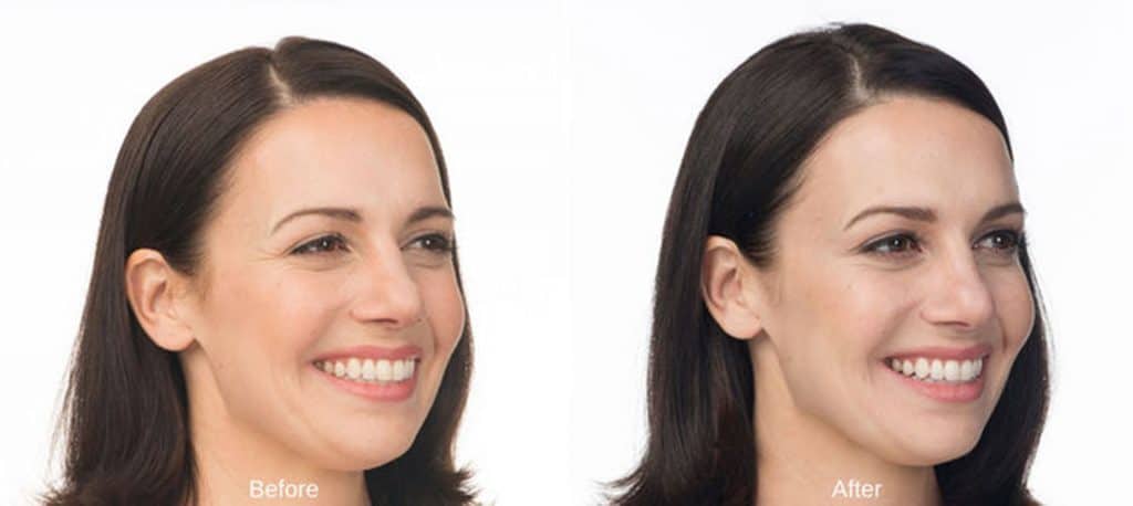 botox before and after Lux Skin & Lasers 4