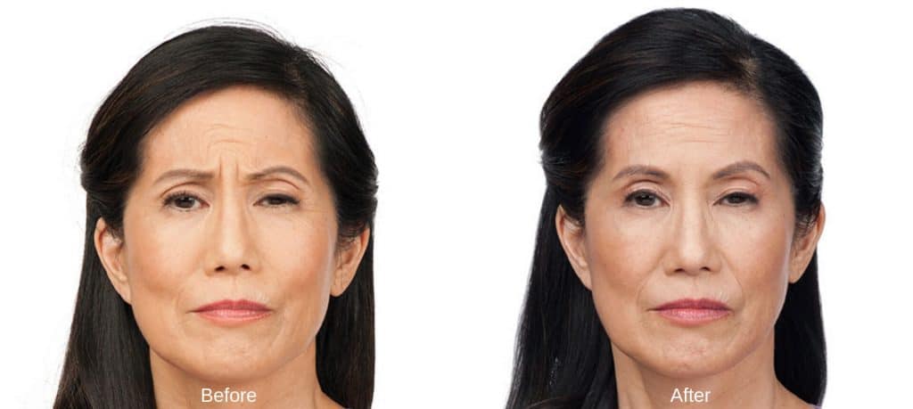 botox before and after Lux Skin & Lasers 1