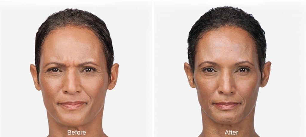 botox before and after Lux Skin & Lasers 2