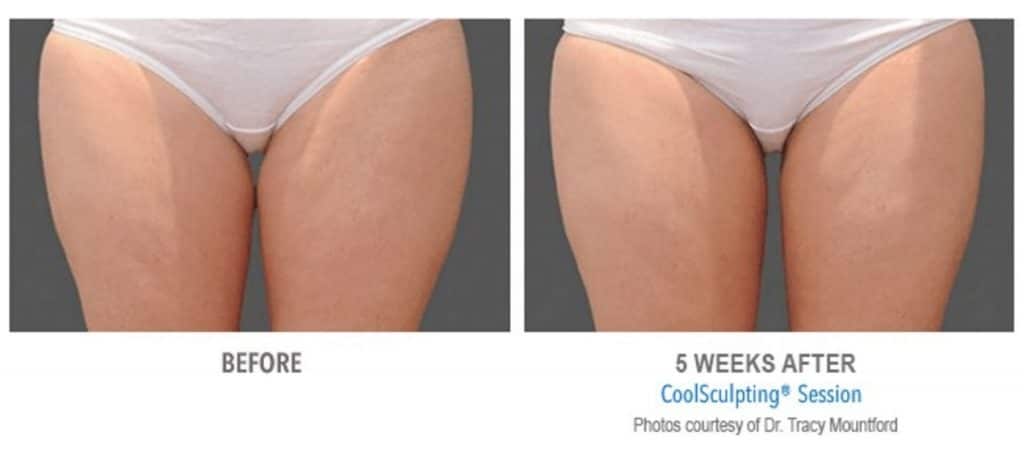 coolsculpting 5 before and after