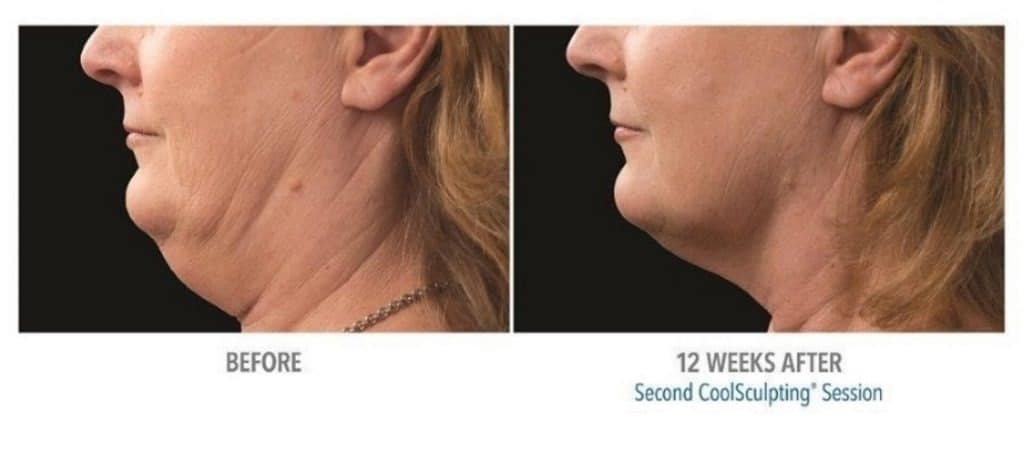 coolsculpting 6 before and after