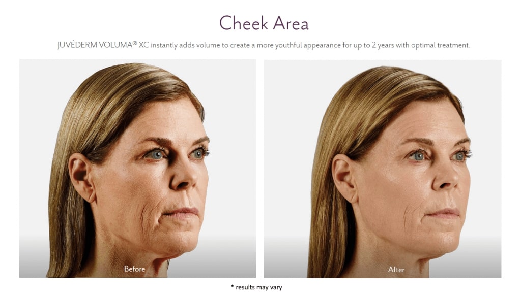 juvederm before and after lux skin & lasers 2