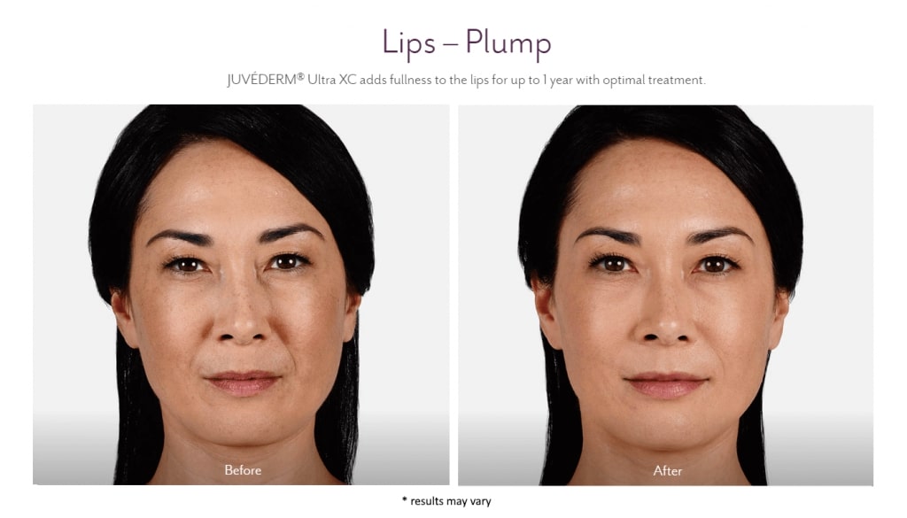 juvederm before and after lux skin & lasers 1
