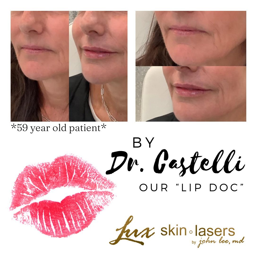 59 yrs old pt loving her fuller lips by Dr Castelli! Fuller lips help appearance of fine lines around the mouth and replace volume lost with aging. **Photo is taken right after her Juvederm filler injection.