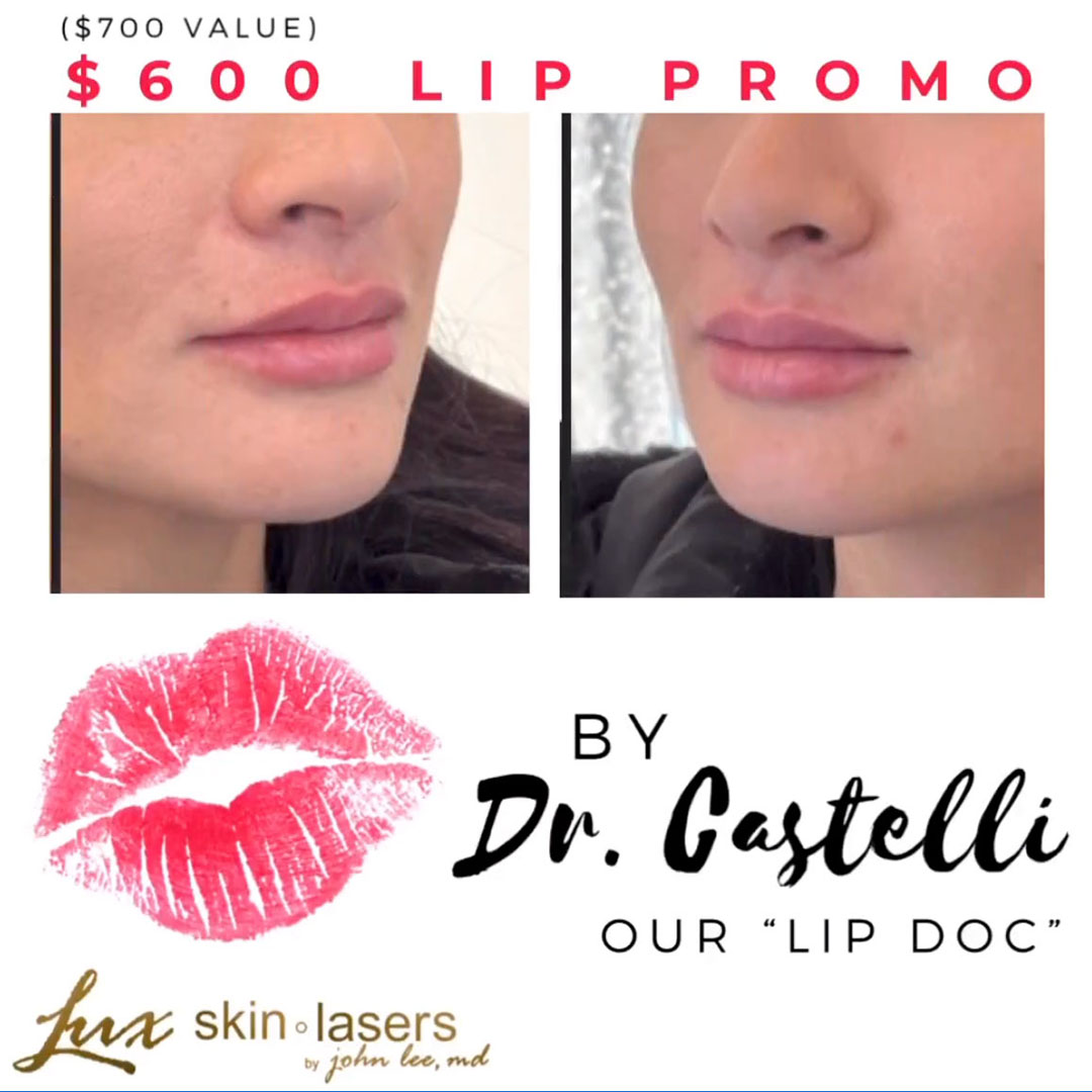 TAKEN RIGHT AFTER TREATMENT- no bruising and lumpiness, just fuller and nicer lips! Treat yourself to fuller lips for $600 with Dr. Castelli– our “LIP DOC”!