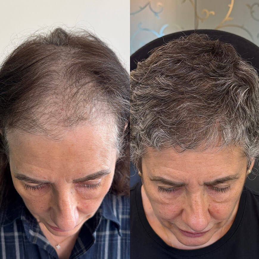 Hair transplant procedure for natural hair restoration.