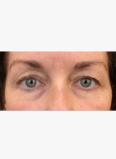 Upper Eyelids – Case 1