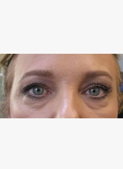 Upper Eyelids – Case 2